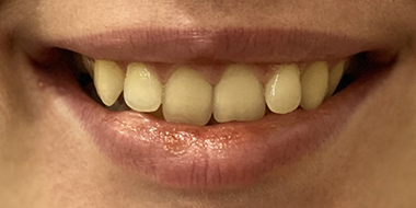 Установка брекетов на задние зубы 'до' в клинике Super Smile кейс 1