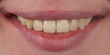 Установка брекетов на задние зубы 'после' в клинике Super Smile кейс 1