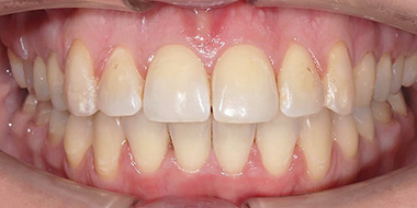 Установка брекетов на задние зубы 'после' в клинике Super Smile кейс 2