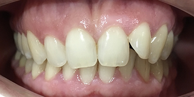 Установка брекетов на задние зубы 'до' в клинике Super Smile кейс 3