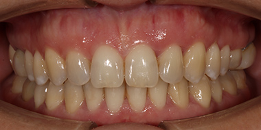 Установка брекетов на задние зубы 'после' в клинике Super Smile кейс 3