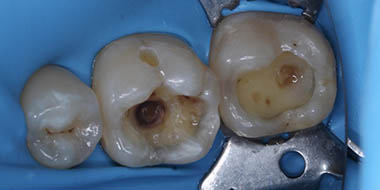 Лечение зубов под микроскопом 'до' в клинике Super Smile кейс 1