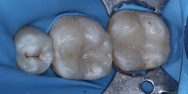 Лечение кариеса корня зуба 'после' в клинике Super Smile кейс 3
