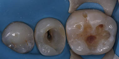 Лечение зубов под микроскопом 'до' в клинике Super Smile кейс 2