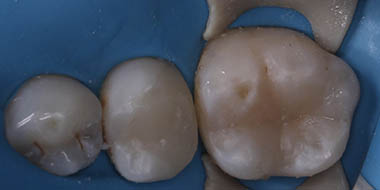 Лечение ткани зуба 'после' в клинике Super Smile кейс 1