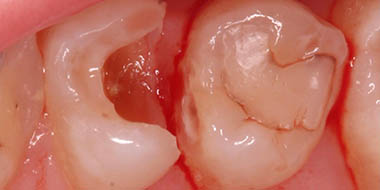 Лечение воспаления зуба 'до' в клинике Super Smile кейс 3