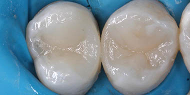 Лечение воспаления зуба 'после' в клинике Super Smile кейс 3