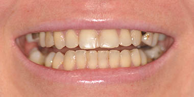 Лечение зубов в рассрочку 'до' в клинике Super Smile кейс 1