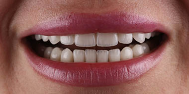 Лечение зубов в рассрочку 'после' в клинике Super Smile кейс 1