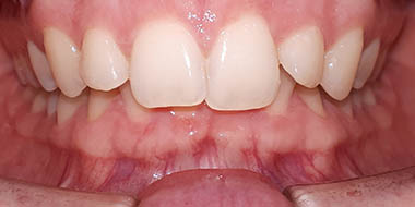 Лечение зубов в рассрочку 'до' в клинике Super Smile кейс 3