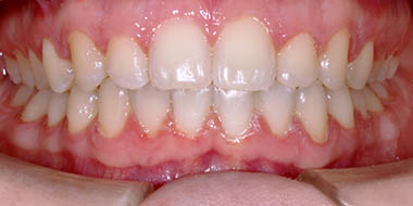 Лечение зубов в рассрочку 'после' в клинике Super Smile кейс 3