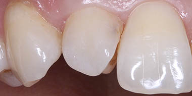 Лечение зубов Icon 'до' в клинике Super Smile кейс 1