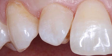 Лечение зубов Icon 'после' в клинике Super Smile кейс 1