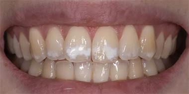 Лечение зубов Icon 'до' в клинике Super Smile кейс 2