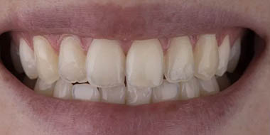 Лечение зубов Icon 'после' в клинике Super Smile кейс 2