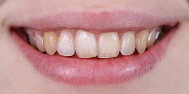 Лечение зубов Icon 'до' в клинике Super Smile кейс 3