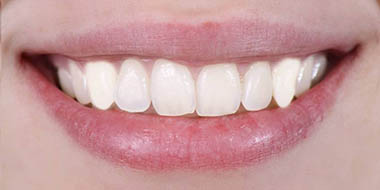 Лечение зубов Icon 'после' в клинике Super Smile кейс 3