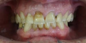 Протезирование зубов нижней челюсти 'до' в клинике Super Smile кейс 3