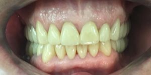 Протезирование зубов нижней челюсти 'после' в клинике Super Smile кейс 3