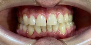Установка виниров на нижние зубы 'до' в клинике Super Smile кейс 1