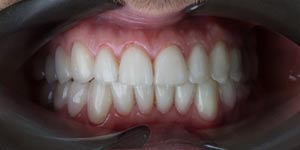 Установка виниров на нижние зубы 'после' в клинике Super Smile кейс 1